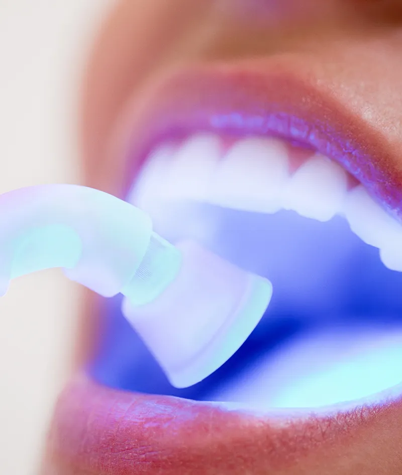 Cosmetic Bonding Procedure