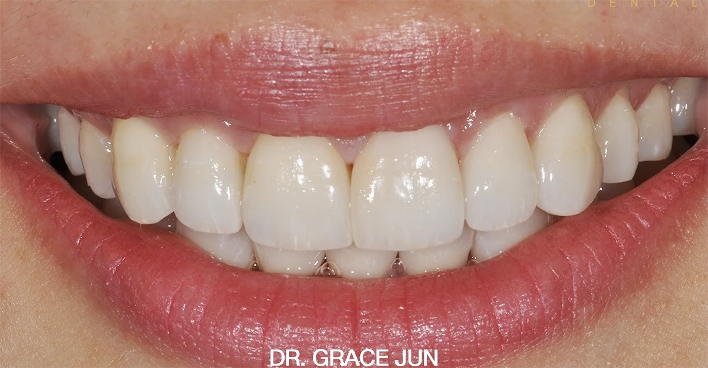 Cosmetic Smile Makeover After