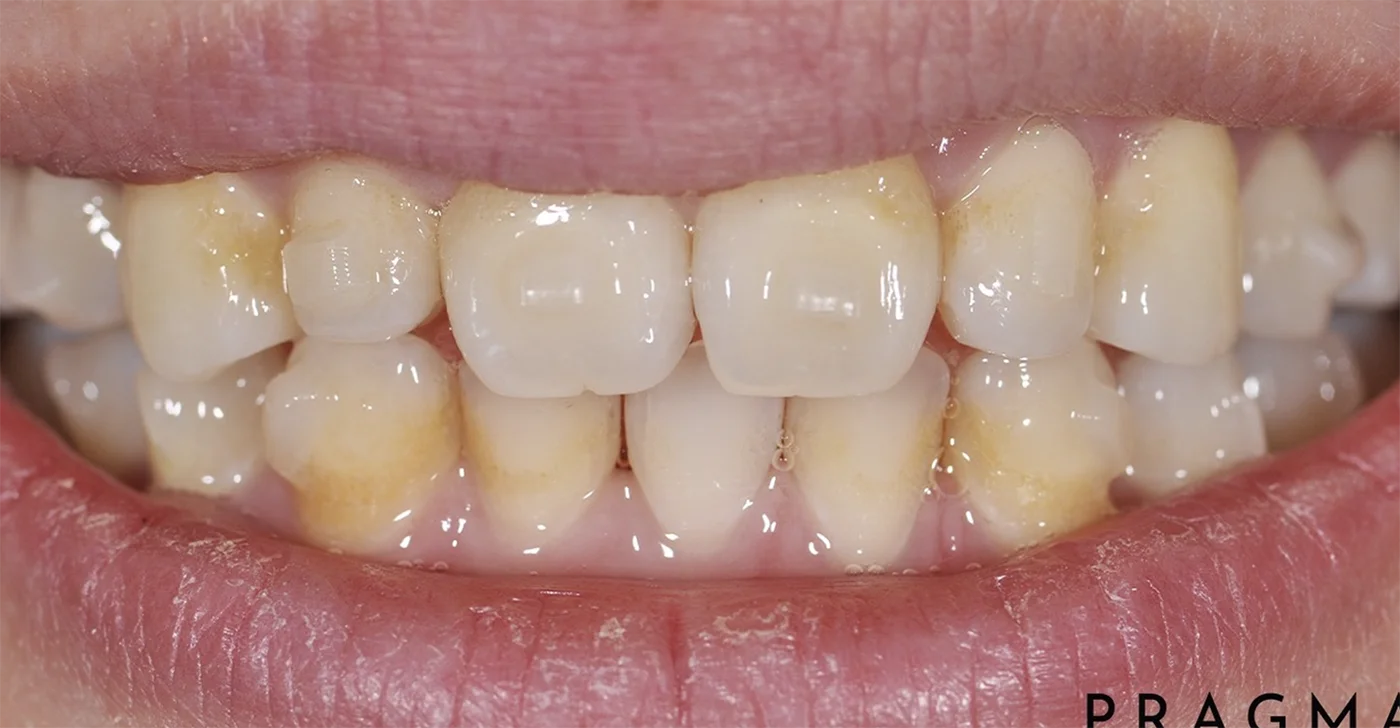 Cosmetic Smile Makeover Before