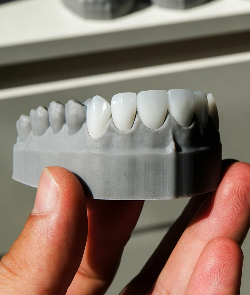 Porcelain Veneers Fitting on Dental Impressions
