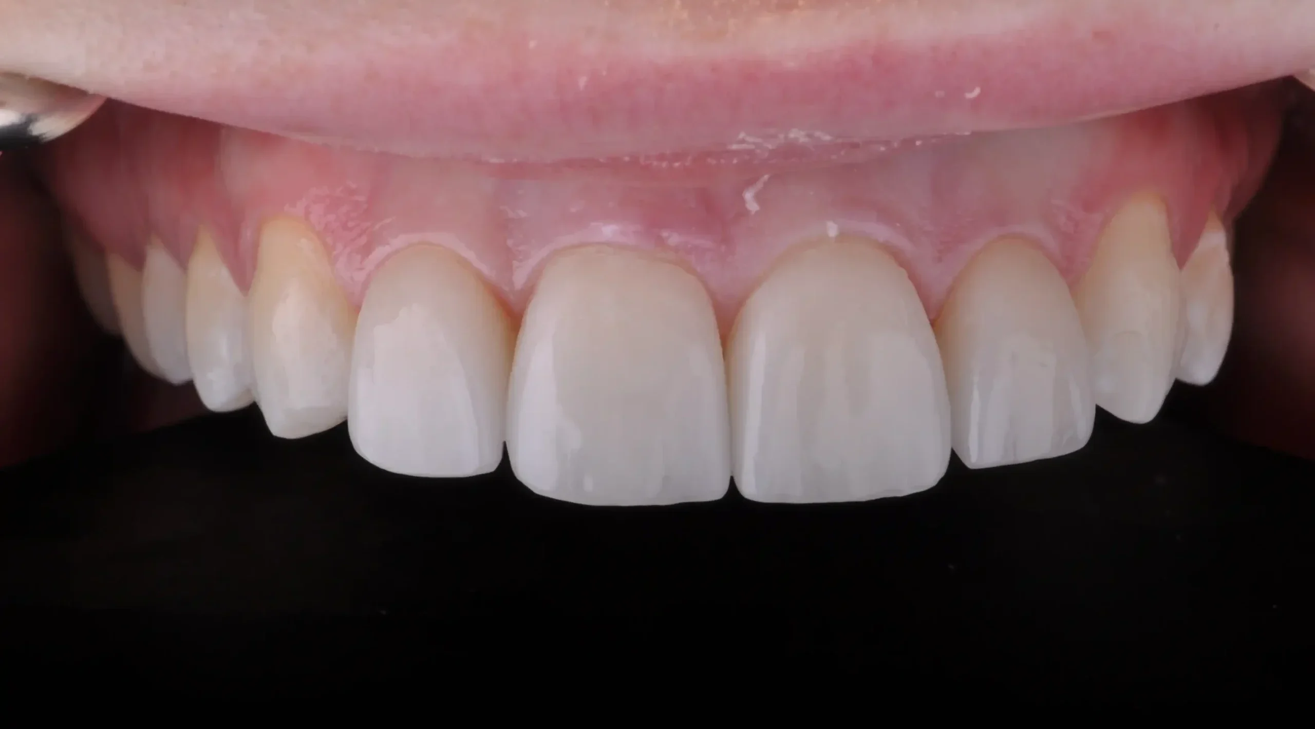 HARA-Smile-Transformations Perfect smile transformation by HARA Dental
