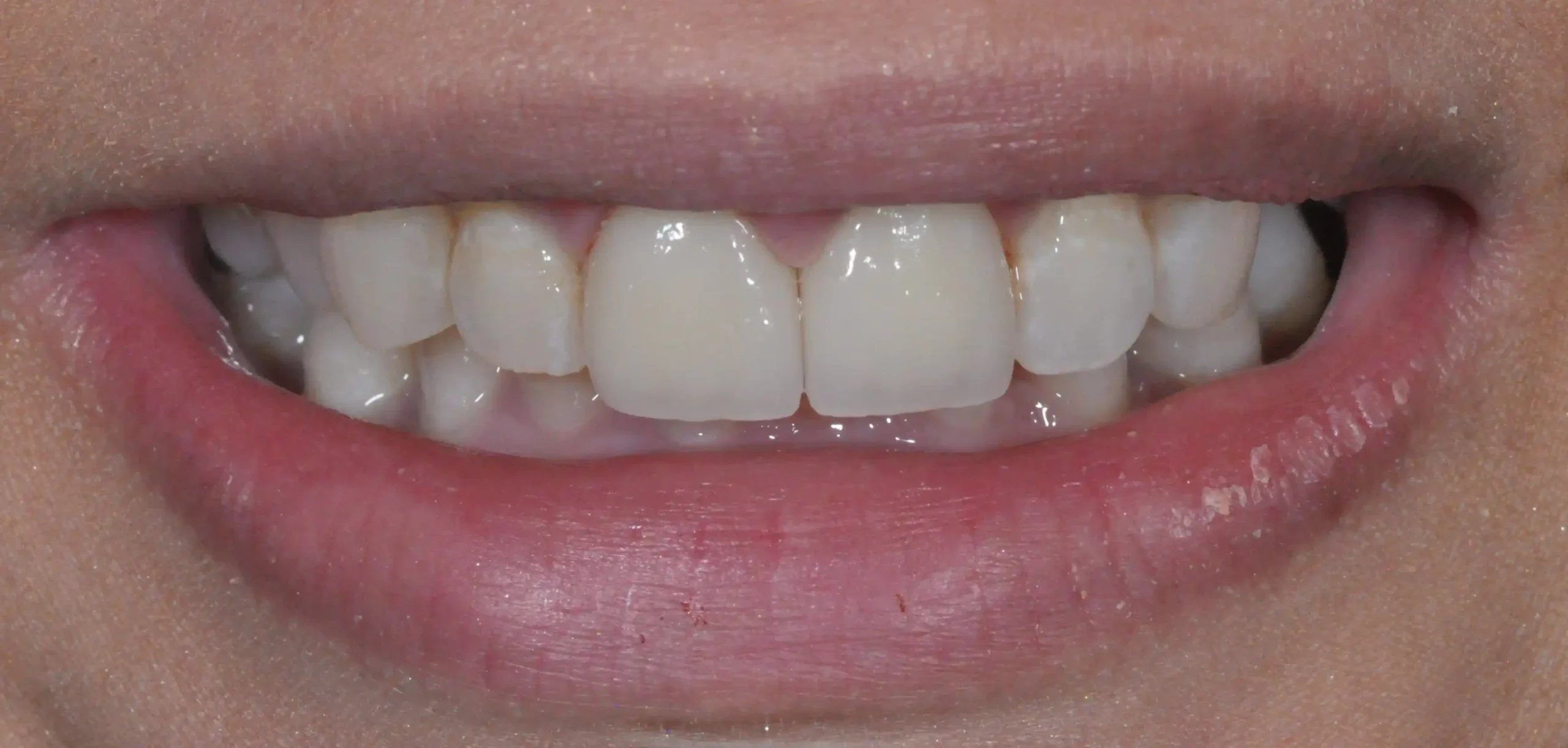 HARA Dental perfect smile transformation