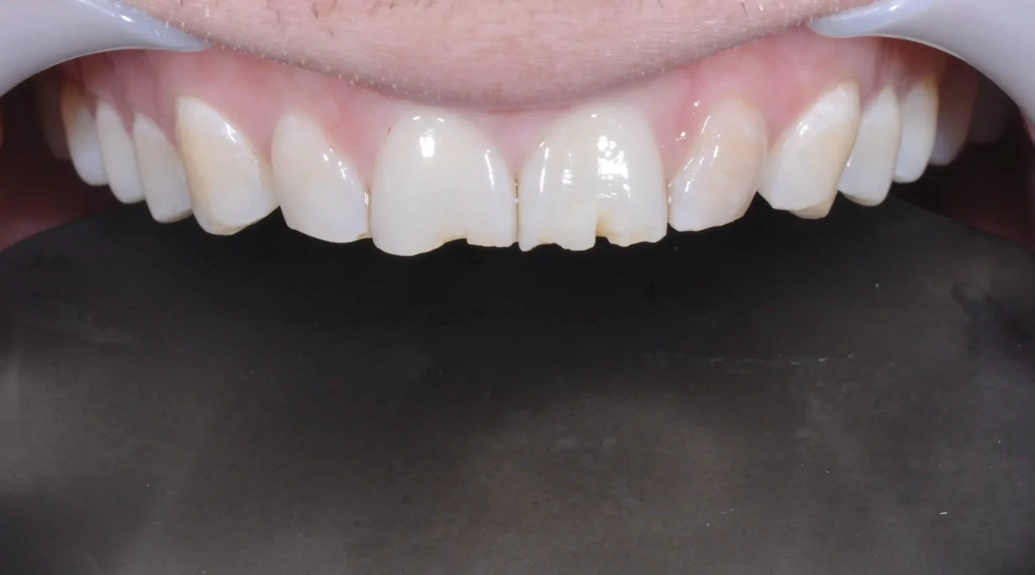 HARA-smile-transformation- HARA before and after smile transformation