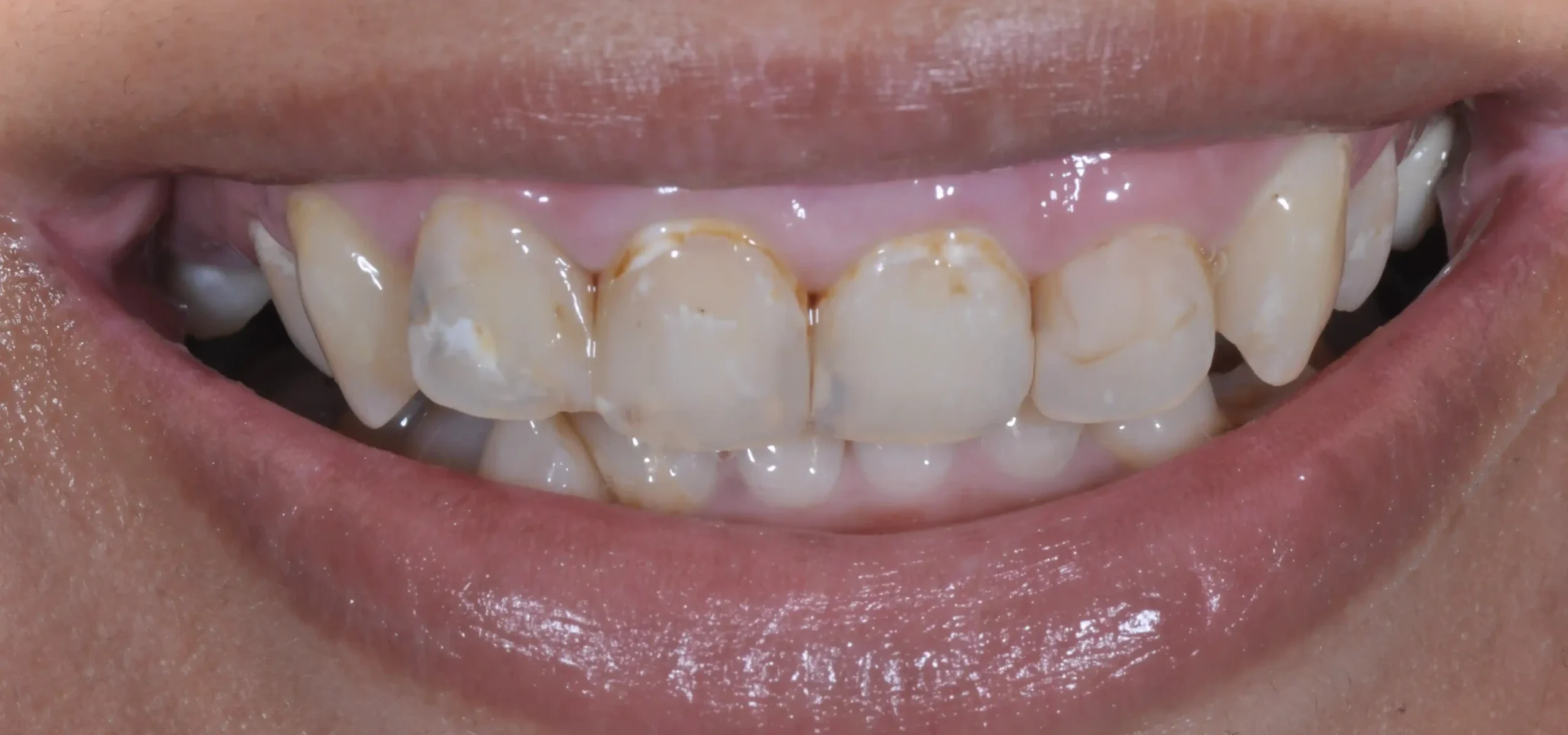 HARA Dental smile transformations