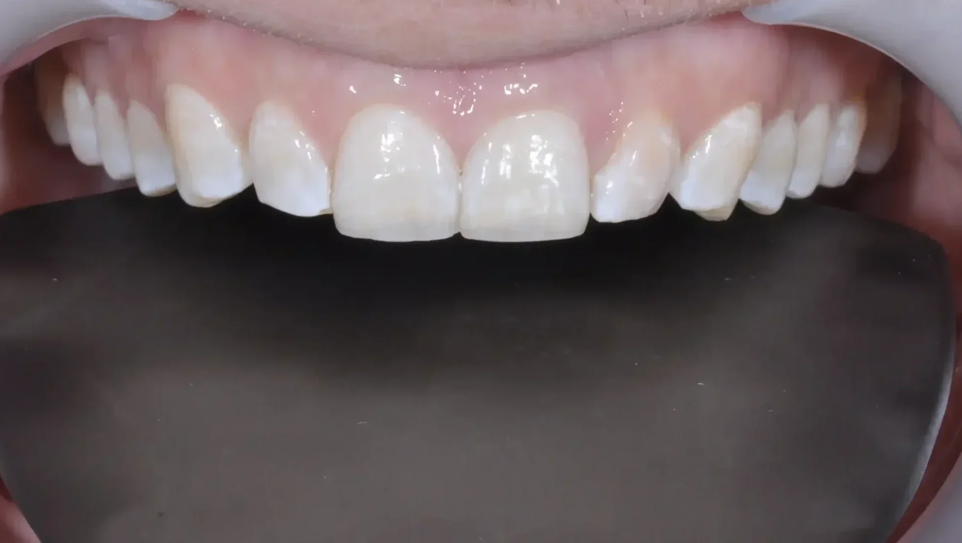 Smile-transformation-by-HARA-Dental Smile-transformation-by-HARA-Dental