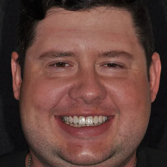 Drew real patient with treatment at Hara Cosmetic Dentistry