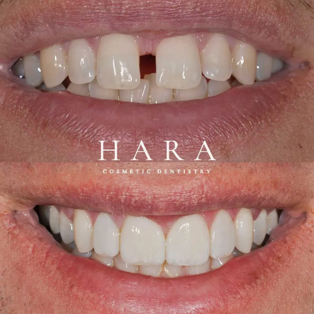 Jon real patient before after treatment at Hara Cosmetic Dentistry