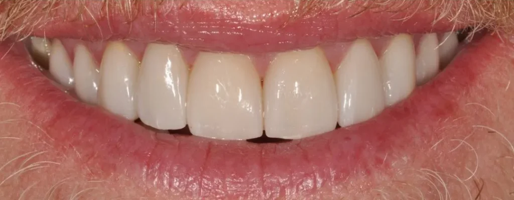 No-Prep-Dental-Veneers-in-Oklahoma-City