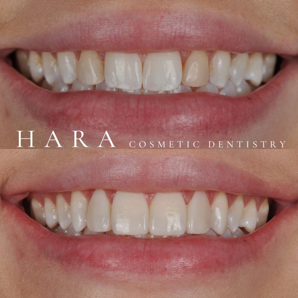 Before and after cosmetic dentistry smile makeover showing whiter and more balanced teeth at Hara Cosmetic Dentistry