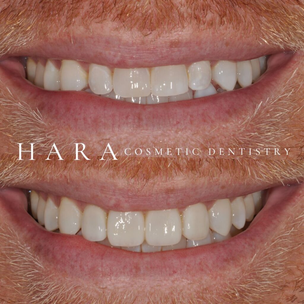 Patient smile before and after cosmetic dentistry treatment with natural looking results at Hara Cosmetic Dentistry