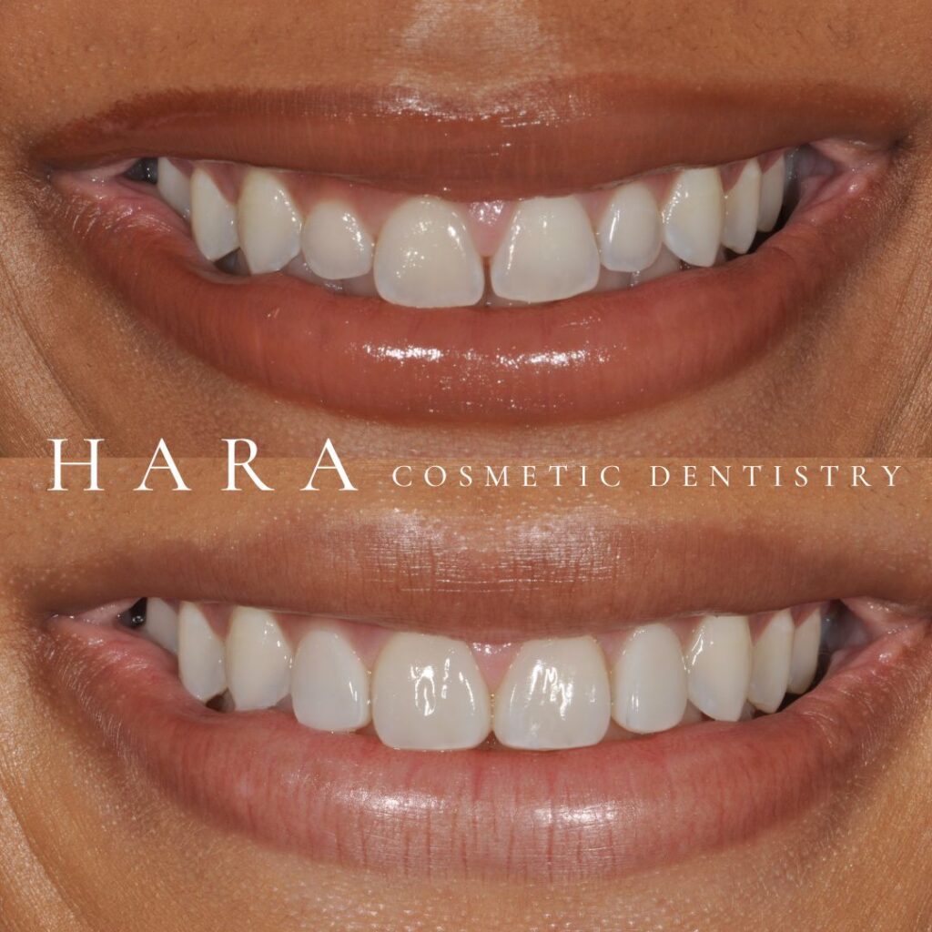 Before and after cosmetic smile makeover with brighter and more symmetrical teeth at Hara Cosmetic Dentistry