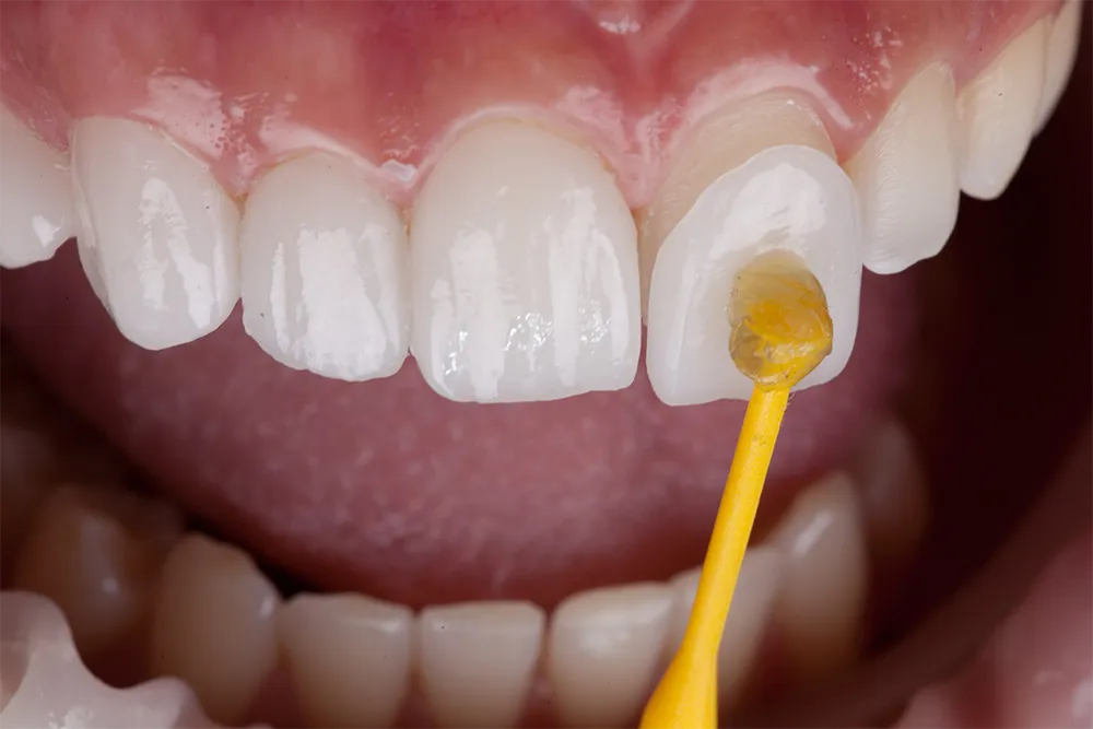 Porcelain Veneers Treatment At HARA Cosmetic Dentistry