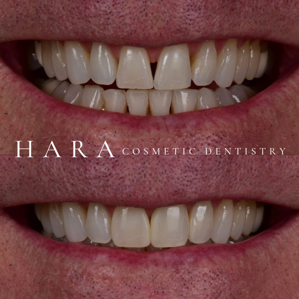 Before and after smile enhancement showing improved tooth, alignment and brightness at Hara Cosmetic Dentistry