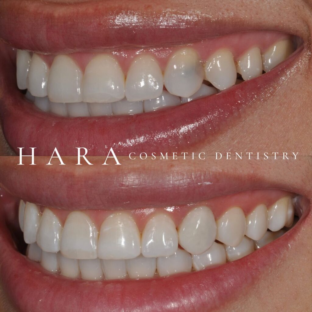 Before and after dental veneers creating a brighter and more confident smile at Hara Cosmetic Dentistry