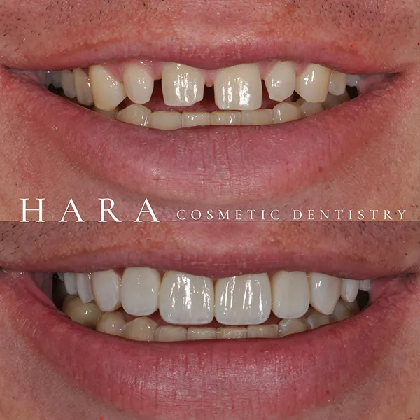 Drew Actual Hara Patient Smile Makeover Before After