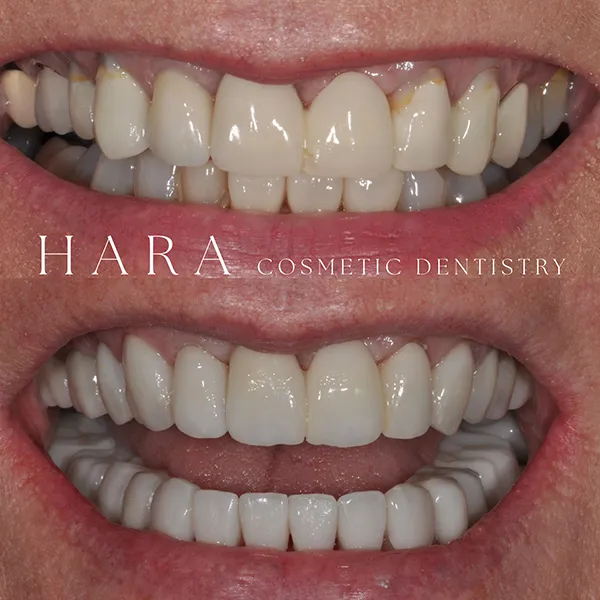 Lillian Actual Hara Patient Smile Makeover Before After
