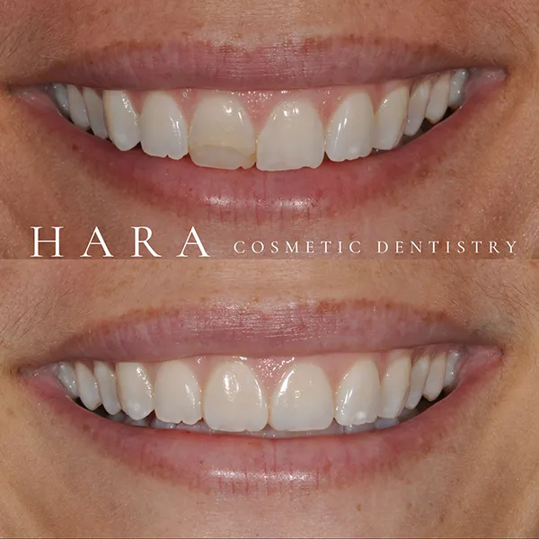Perla Real Veneers Patient Before After